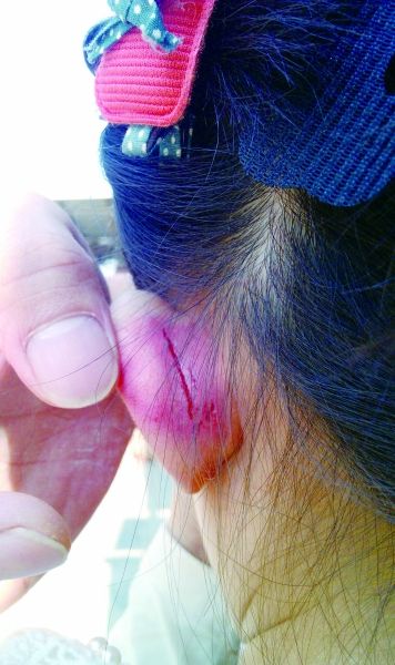 　　女童的耳朵被老師揪裂。圖片由女童家人提供