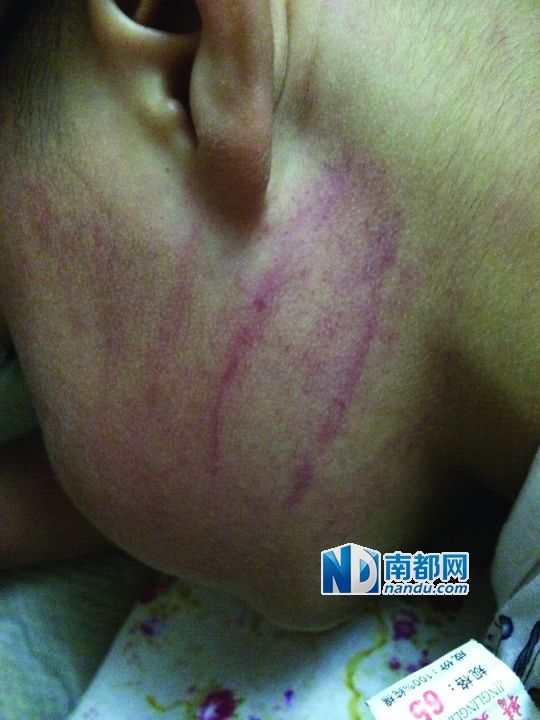 小逸臉上淤痕清晰可見。