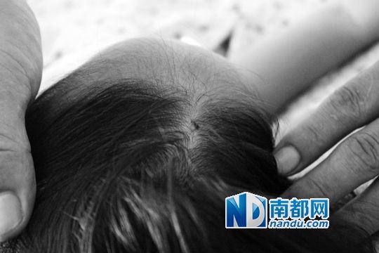 女童頭上被扎的針孔（圓圈處）。賈先生說(shuō)，被扎不到三秒鐘，女兒就昏了。