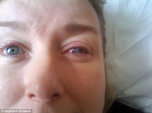 恐怖慎入！隱形眼鏡致英女子摘除眼球
