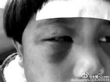 6月2日，網(wǎng)曝渭南市臨渭區(qū)一不滿5歲的女童遭奶奶毆打，眼圈青腫，引起網(wǎng)友關(guān)注，但孩子父母和爺爺均稱是摔倒導(dǎo)致。相關(guān)部門介入調(diào)查發(fā)現(xiàn)確為奶奶毆打所致，鑒于其身體原因已進(jìn)行批評(píng)教育。