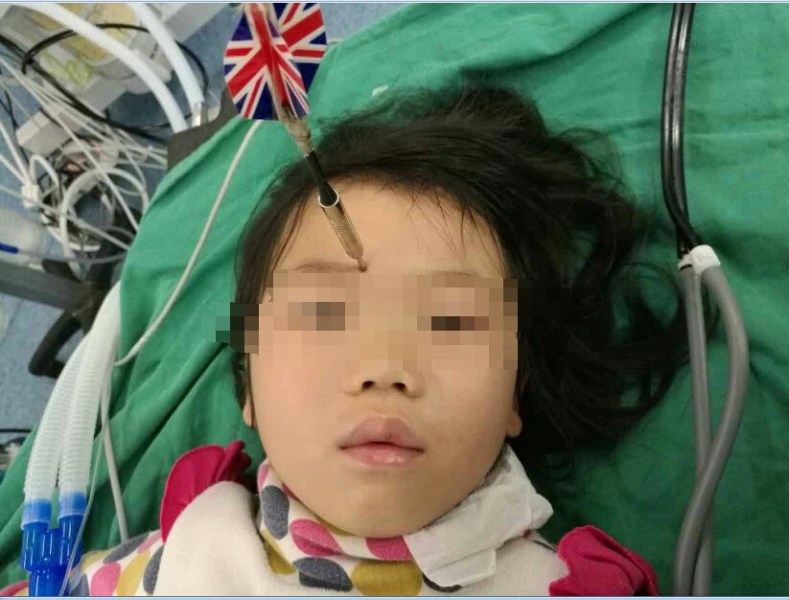 十多公分長(zhǎng)的飛鏢穩(wěn)穩(wěn)地 ” 定 ” 在了一名六歲半的女童額頭上，小青一家人凌晨從長(zhǎng)順趕到貴醫(yī)附院急診室時(shí)，看到如此慘烈的情況，接診醫(yī)生都嚇了一跳。詳細(xì)詢問下得知，原來是七歲的哥哥和六歲半的表妹在玩耍時(shí)，哥哥不慎將路邊撿來的真飛鏢扎到了妹妹的額頭上。