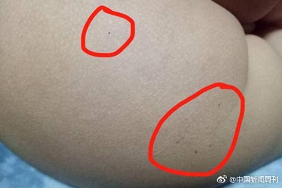 據(jù)多名紅黃藍(lán)(新天地分園)家長反映，孩子腿部、屁股、腋下出現(xiàn)針眼。
