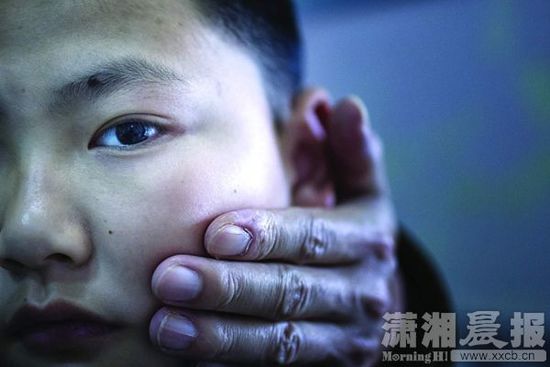 1月13日，小玨的父親心疼地摸著兒子的臉。
