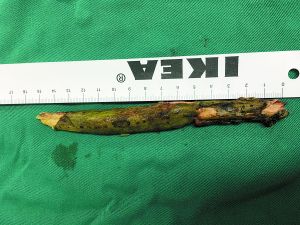 插入男子腦內的樹枝。