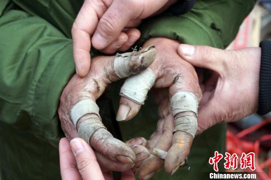 圖為由于常年拾荒，老人雙手布滿傷口。周小云 攝